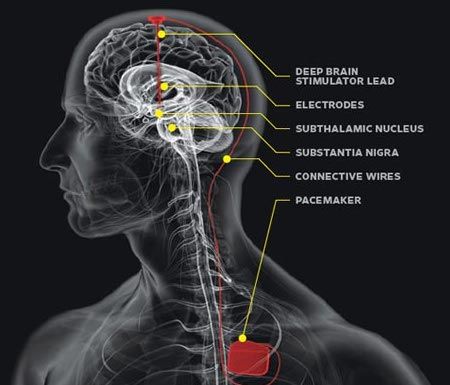 Depuis quelques années, la stimulation électrique a révolutionné le domaine médical dans le traitement de la maladie de Parkinson. Les récentes avancées scientifiques, notamment la réalisation d’une carte du cerveau en 3 dimensions, ont permis d’améliorer la précision de cette technique qui pourrait bien devenir LE traitement privilégié dans la maladie de Parkinson. Explications. 