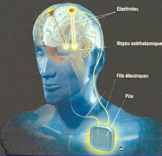 Stimulation cérébrale électrique